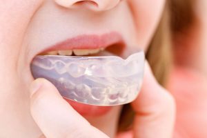 Капы Myosa от скрежета зубов: в чем их преимущества