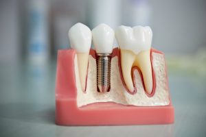 Как делается имплантация зубов и безопасно ли это?
