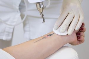 Почему стоит выбрать удаление татуировок лазером